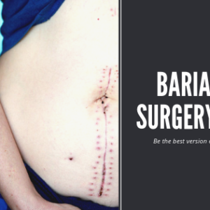 Get Bariatric Surgery Loan Today For A Better Transformation